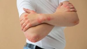 Fungal infection: The first sign of fungal infection is crust and itching on the skin, know what the doctor says