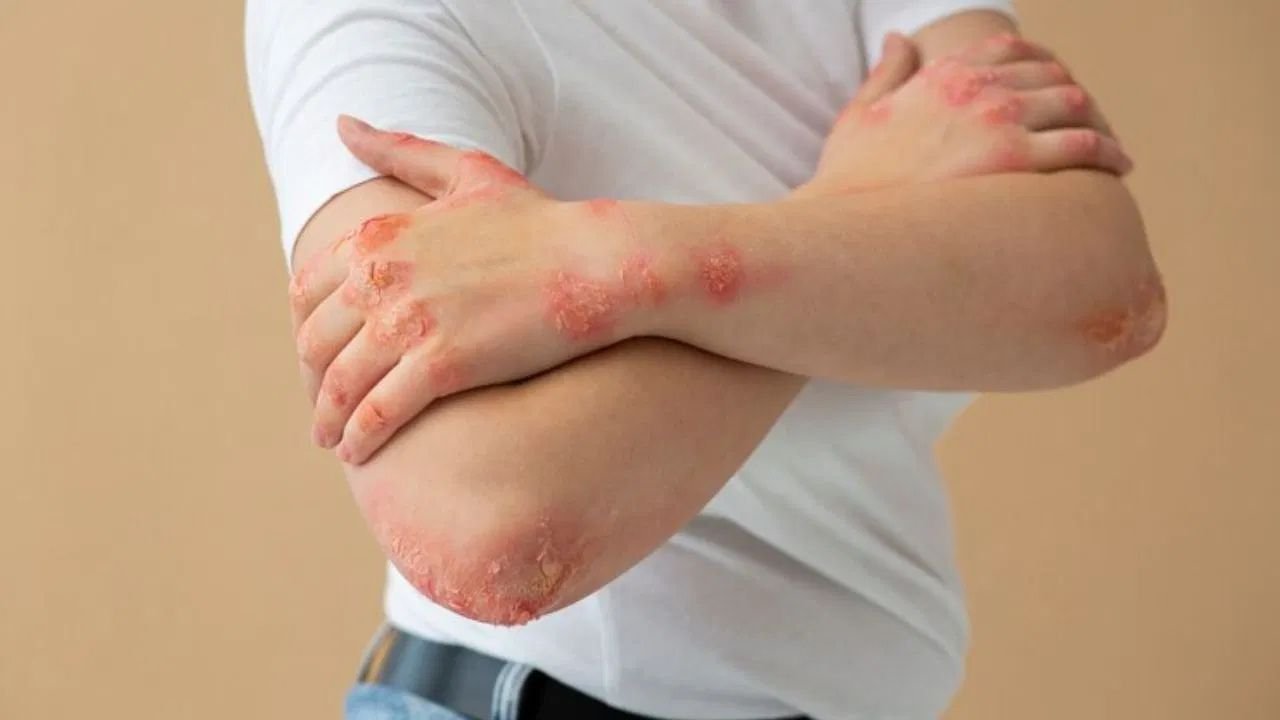 Fungal infection: The first sign of fungal infection is crust and itching on the skin, know what the doctor says