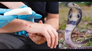 First Aid For Snake Bite: What to Do Immediately After a Snake Bite! Life-Saving Tips Everyone Should Know