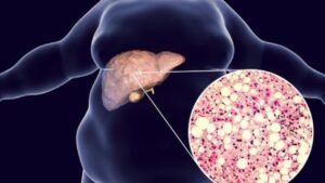 Fatty Liver is a danger signal! But this one drink can be a miraculous cure in just 14 days