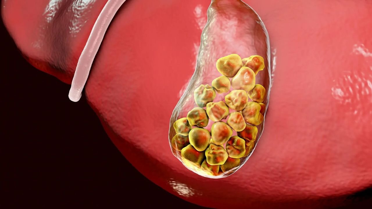 If you want to avoid gallbladder stones, then immediately give up these 5 bad habits, otherwise the risk will increase!