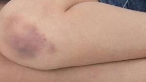 Health Tips: Does your skin get scars without injury? Find out what deficiency is causing this!