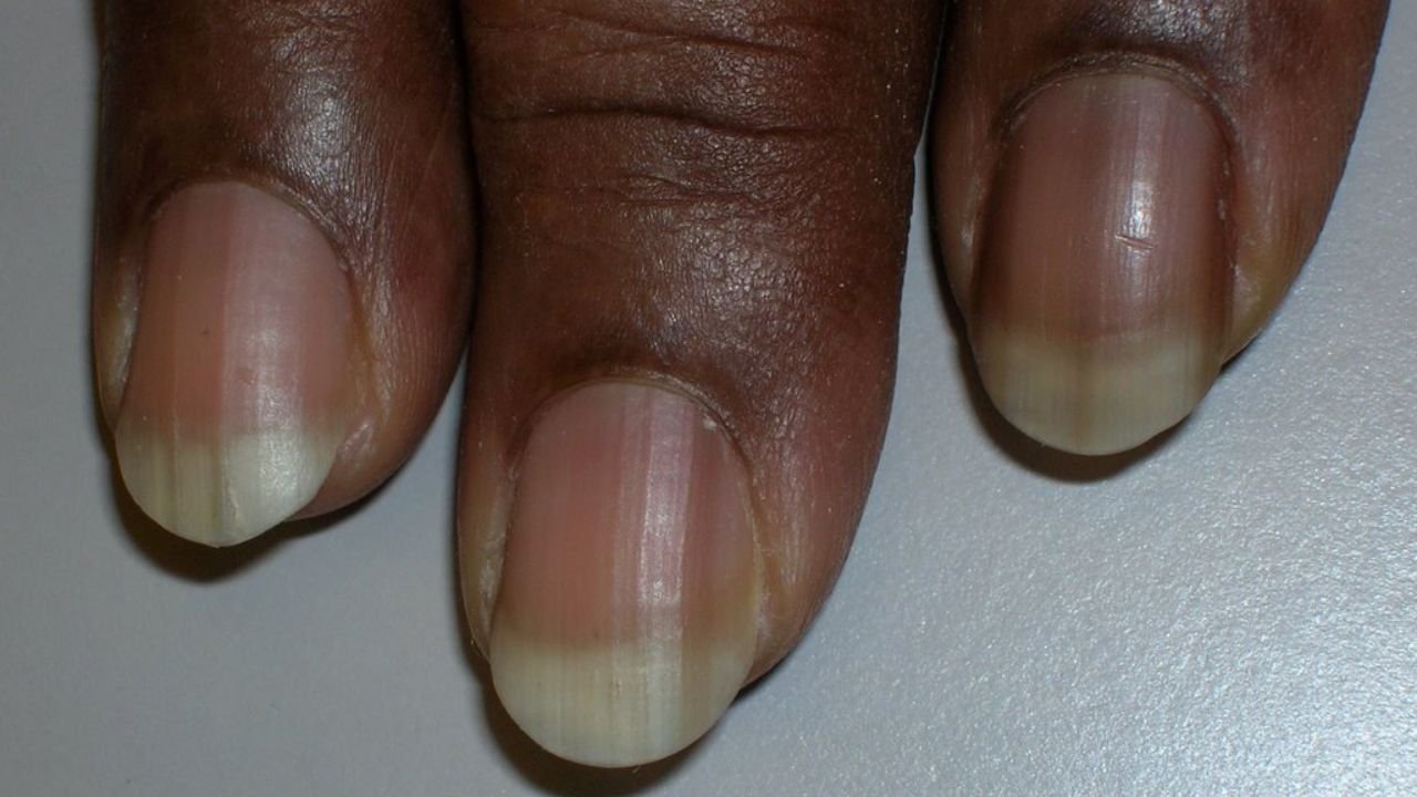 Line On Nails: Are your beautiful nails losing their shine? These health problems could be the reason behind them breaking, turning yellow, or turning black.