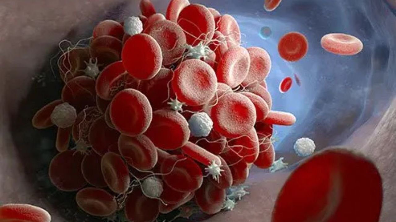 World Thrombosis Day: Do not ignore swelling and pain in the legs, know the hidden danger!