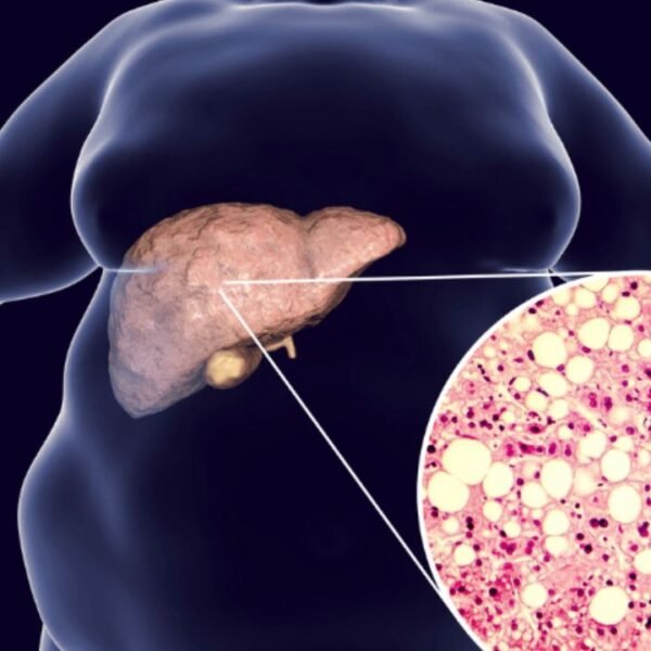 Fatty Liver Symptoms: Fatty liver is not normal! If you notice these subtle symptoms, you…
