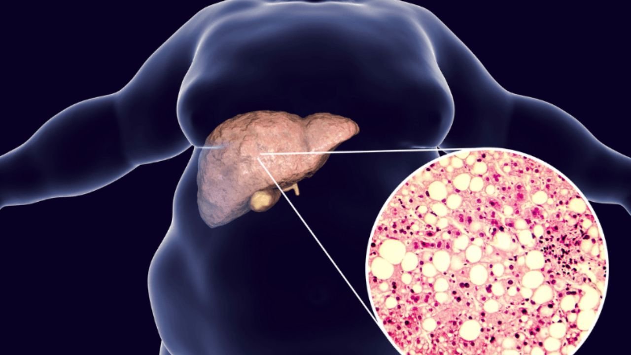 Fatty liver is not normal! If you notice these subtle symptoms, you should know the danger is upon you.