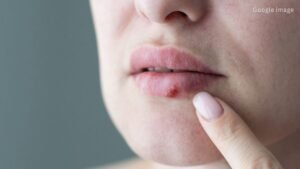 Post Fever Lip Sores Could Signal Herpes Infection Doctors Warn of Serious Risk