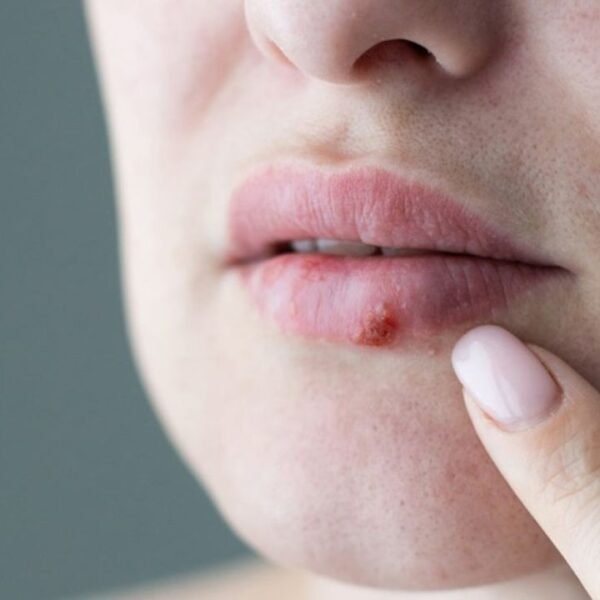 Post Fever Lip Sores Could Signal Herpes Infection Doctors Warn of Serious Risk