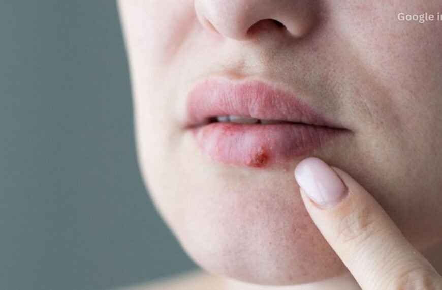 Post Fever Lip Sores Could Signal Herpes Infection Doctors Warn of Serious Risk