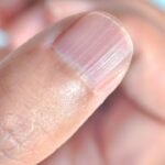 Vertical Lines on Nails Could Indicate Vitamin Deficiency or Serious Internal Disorders