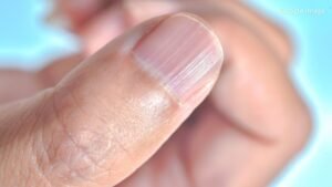 Vertical Lines on Nails Could Indicate Vitamin Deficiency or Serious Internal Disorders