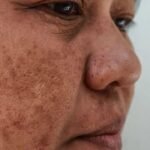 Hidden Melasma Skin Disorder Behind Dark Facial Spots Affecting Millions Worldwide Revealed