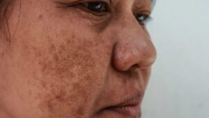 Hidden Melasma Skin Disorder Behind Dark Facial Spots Affecting Millions Worldwide Revealed