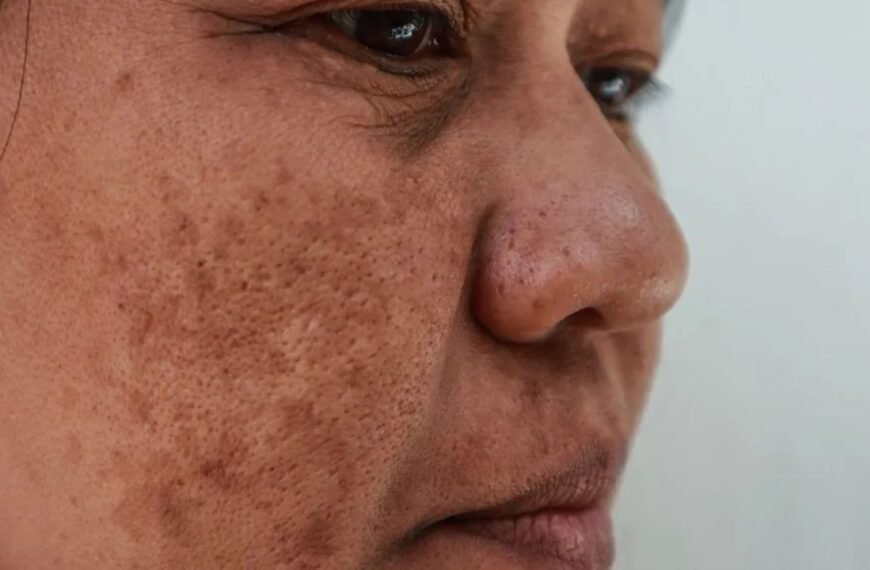Hidden Melasma Skin Disorder Behind Dark Facial Spots Affecting Millions Worldwide Revealed