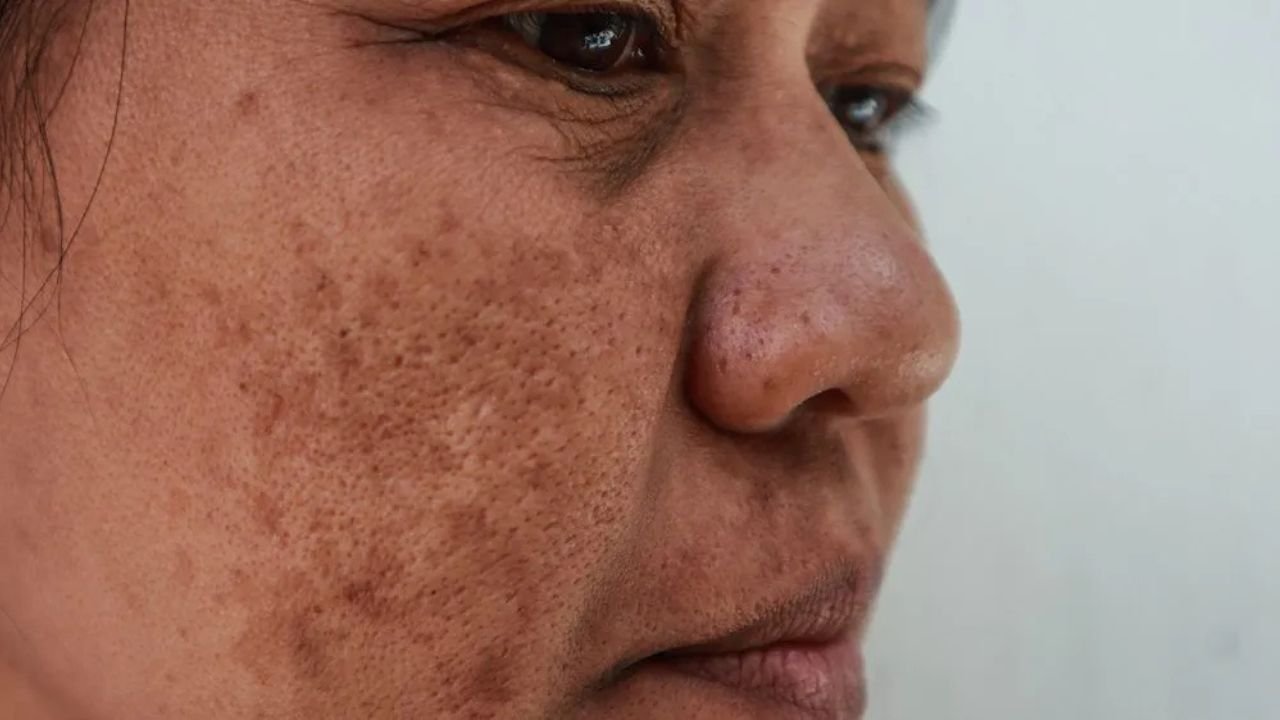 Hidden Melasma Skin Disorder Behind Dark Facial Spots Affecting Millions Worldwide Revealed